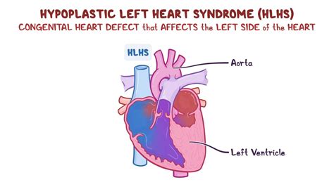 Hypoplastic left heart syndrome: Year of the Zebra 2024: Video, Causes, & Meaning | Osmosis