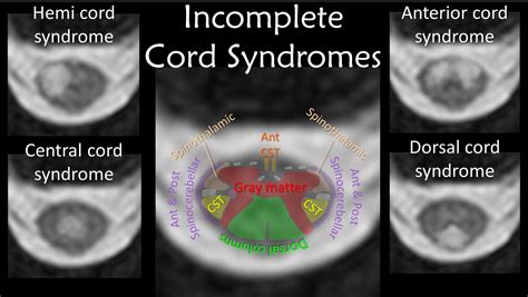 Anterior Cord Syndrome Mri