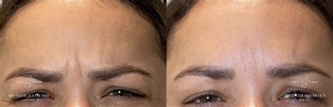 Image result for Botox Examples