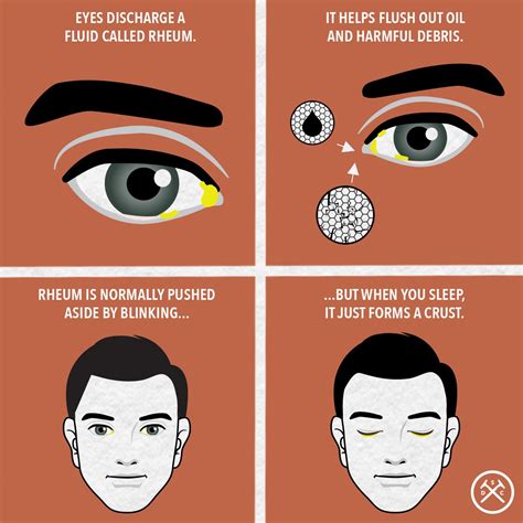 Rheum Eye