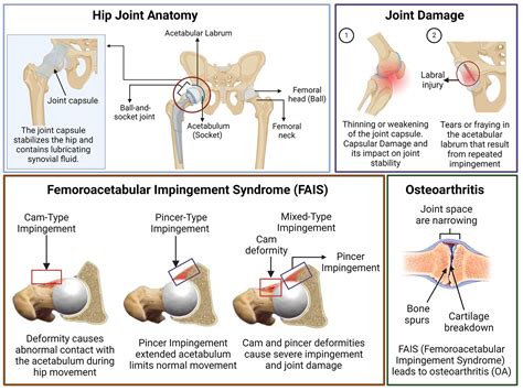 Outcomes and complications of hip arthroscopy for femoroacetabular impingement syndrome: A ...