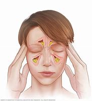 Image result for sinusitis