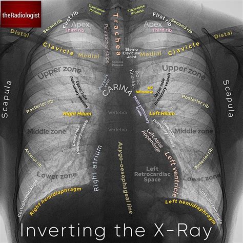 How to read chest xray in 8 steps a powerful guide in 2023 – Artofit