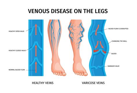 Venous Disease Of Legs Infographics Poster 10317111 Vector Art at Vecteezy
