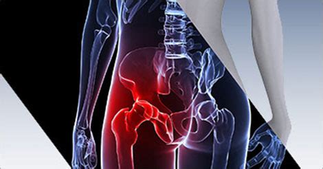 Why Osteoporosis is more common in Women? Know Causes & Symptoms
