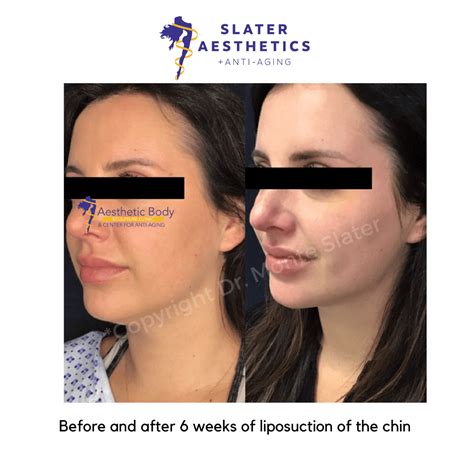 Vampire Breast Lift | Thermi Breast Lift | Fat Transfer to the Breasts