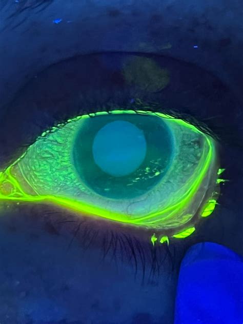 The crohnie struggle So I got my colonoscopy and upper endoscopy done and woke up asking the ...