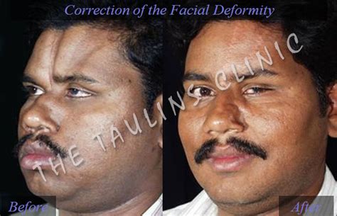 Facial Deformity Correction Bangalore, INDIA