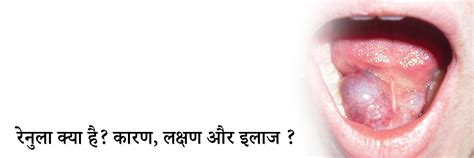 रेनुला क्या है? कारण, लक्षण और इलाज | Ranula Meaning & Treatment in ...