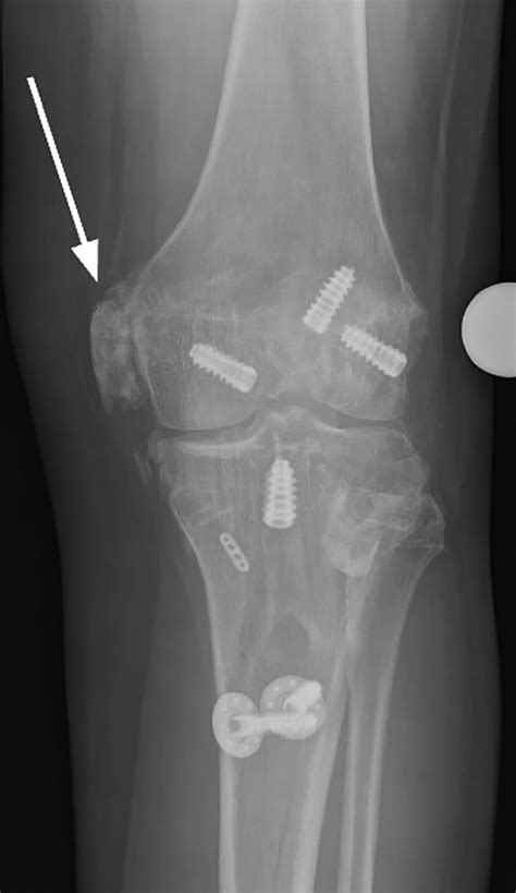 Excision of Femoral Heterotopic Ossification and Lysis of Adhesions ...