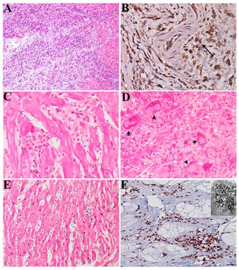 Immunomodulating and Immunosuppressive Therapy for Virus-Negative ...