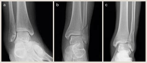 Ankle fractures and their management - Surgery - Oxford International Edition
