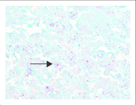 Image result for Acid-Fast Bacilli Staining Method