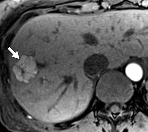 Characteristics and Distinguishing Features of Hepatocellular Adenoma and Focal Nodular ...