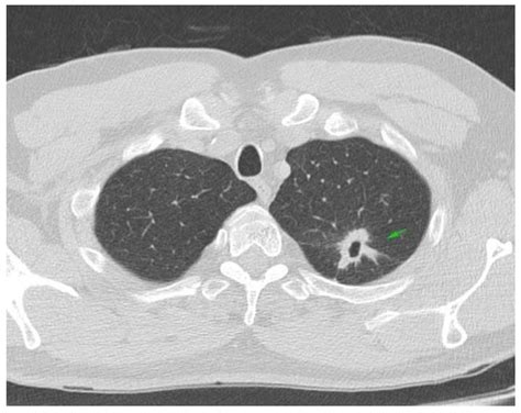 Type I Diabetes—A Rare Adverse Event Described in Patients Receiving ...