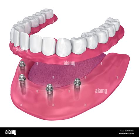 Ball Attachments For Implant Overdentures at Brooke Plume blog