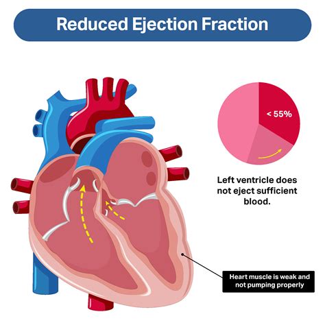 Weak Heart Muscle