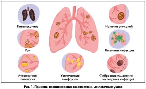 Доброкачественные опухоли легких и бронхов: клинические ...