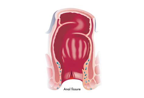 Anal Fissure Pain Relief in Singapore | Ark Surgical Practice