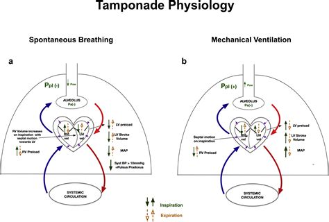 Perioperative implications of pericardial effusions and cardiac ...