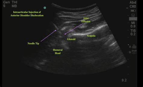 Image result for Shoulder Injection Fluoroscopy