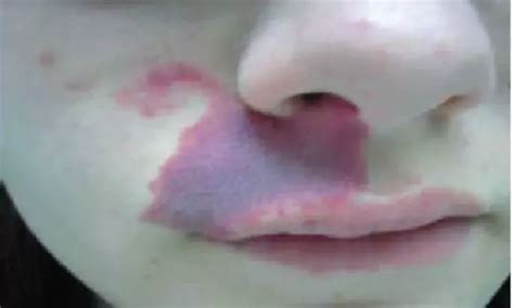 Pulsed dye laser alongside sirolimus and imiquimod cream may ...