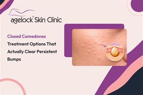 Closed comedones treatment options that actually clear persistent bumps - Agelock Skin & Hair Clinic