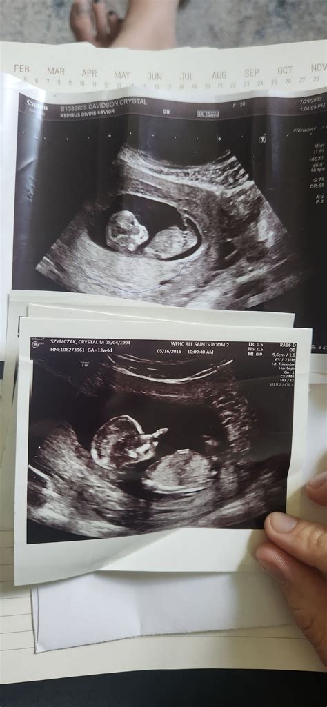 11 week ultrasound - gender | BabyCenter