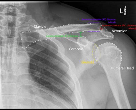 Acromioclavicular Joint Dislocation X Ray