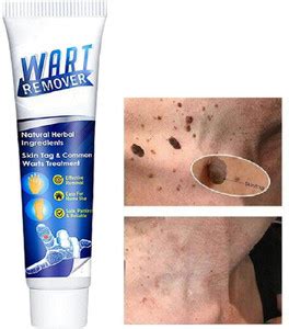 Jiwoo Warts Remover Ointment Wart Treatment Cream Skin Tag Remover ...