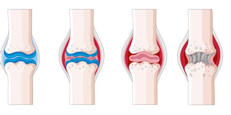 Is RHEUMATOID ARTHRITIS & OSTEOARTHRITIS are same?