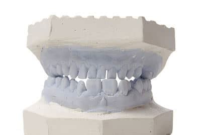 Image result for How to Take Study Models with Plaster Lab