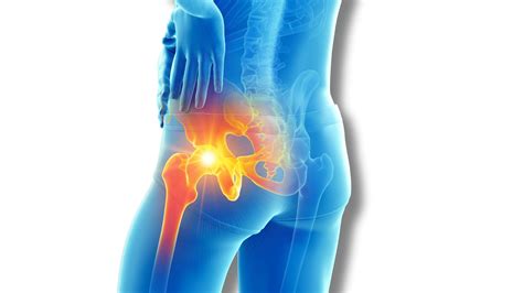 What causes tendonitis in the hip? - ANF