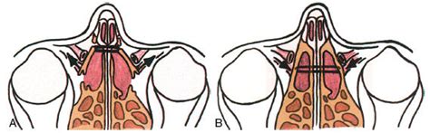 Image result for Transnasal Loop Fixation