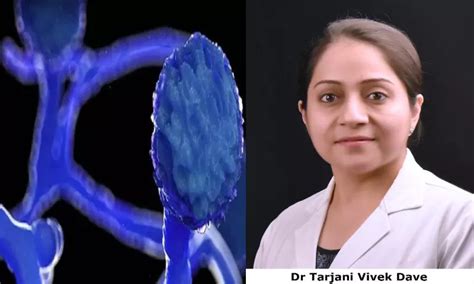 Why this sudden spike in 'black fungus' cases in COVID second wave?