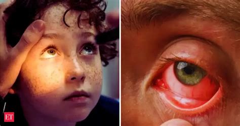 Heatwave effect: High temperatures can cause eye strokes too. Check ...