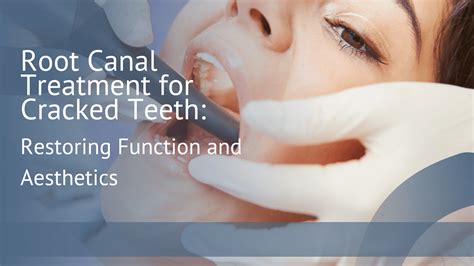 Restoring Cracked Teeth: Understanding Root Canal Treatment - Eastern Idaho Endodontics