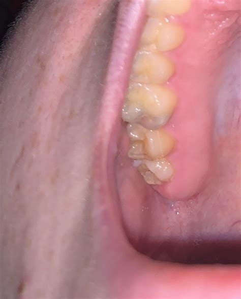 Image result for Discolored Tooth
