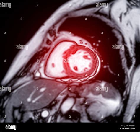 MRI heart or Cardiac MRI ( magnetic resonance imaging ) of heart for ...