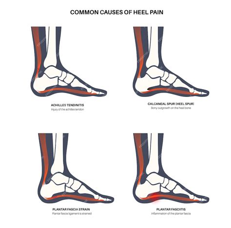 Premium Vector | Common cause of heel pain ankle and foot diseases types diagram calcaneal spur ...
