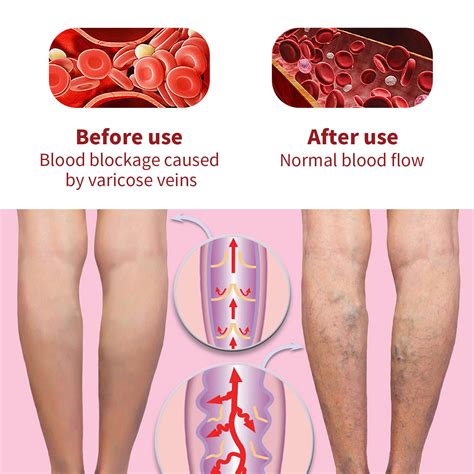 Varicose Veins Miracle Cream Vasculitis Legs | Ubuy India