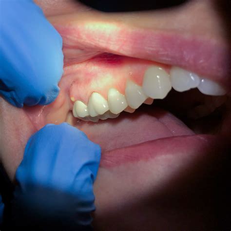 Abscessed Tooth Removal
