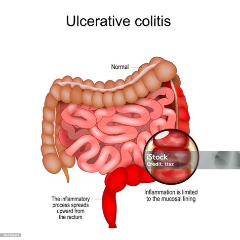 Enfermedad Colitis Ulcerativa