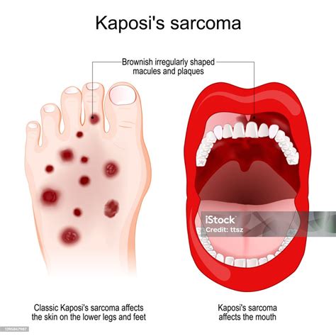 Pictures Of Kaposi's Sarcoma Skin at Jesus Potter blog