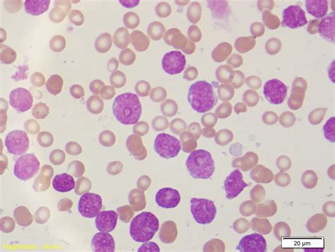 Juntos contra el Cáncer : QUE ES LA LEUCEMIA?