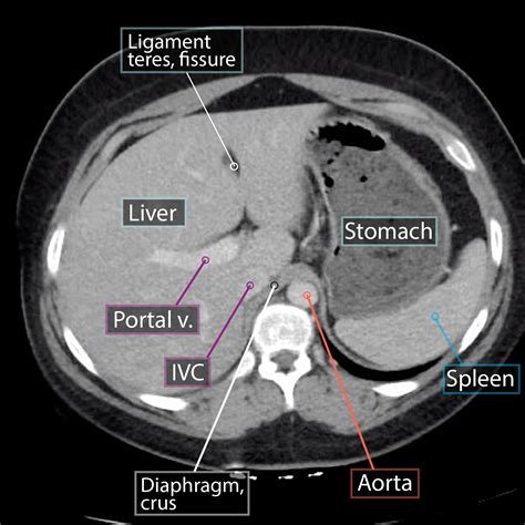 Gross Anatomy Glossary: Axial Abdominal CT | ditki medical & biological sciences