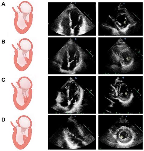 Left Ventricular Papillary Muscle: Anatomy, Pathophysiology, and ...