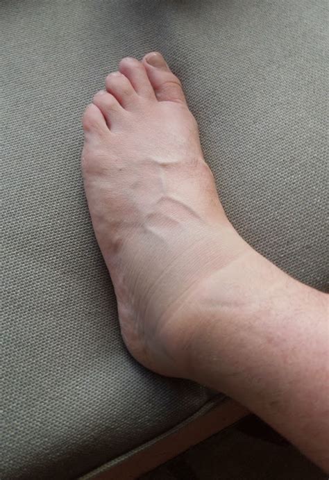 Swollen left ankle