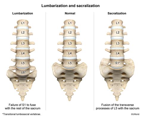 Lumbarisation