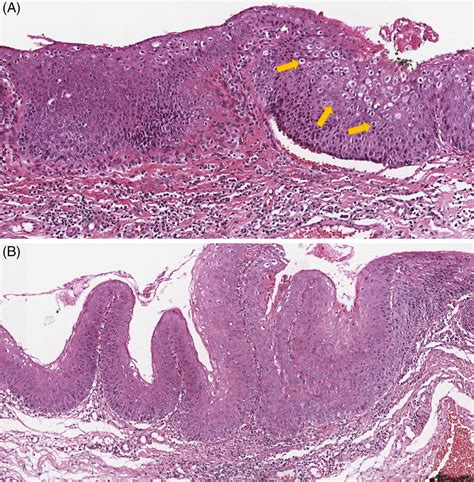 Erythroplasia Of Queyrat Histology